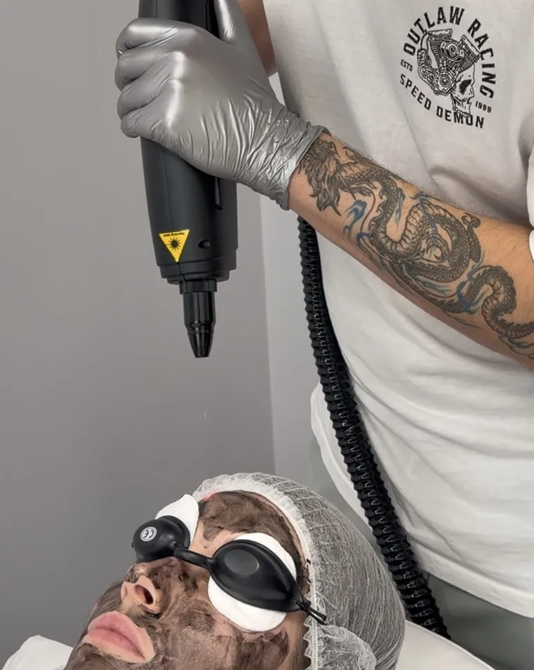 laserowy peeling węglowy