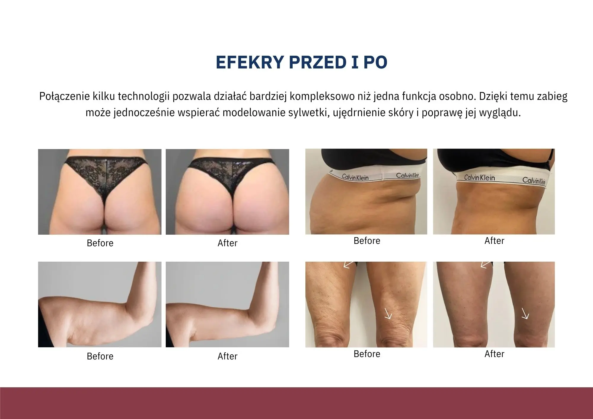 Głowice zabiegowe Muse Shape PRO do endermomasażu RF i kawitacji